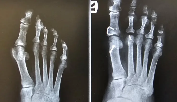 Before and after X-ray of bunion surgery by Dr. Mark Sharobeem: the big toe joint is realigned and the bump corrected after surgery