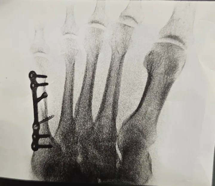 X-ray of a fifth metatarsal fracture repaired with a plate and screws by Dr. Mark Sharobeem