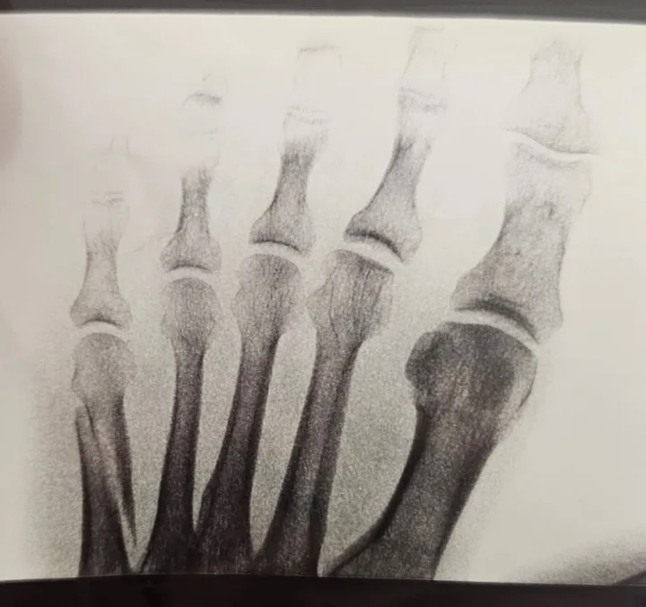 X-ray of a fifth metatarsal fracture on the outside of the foot